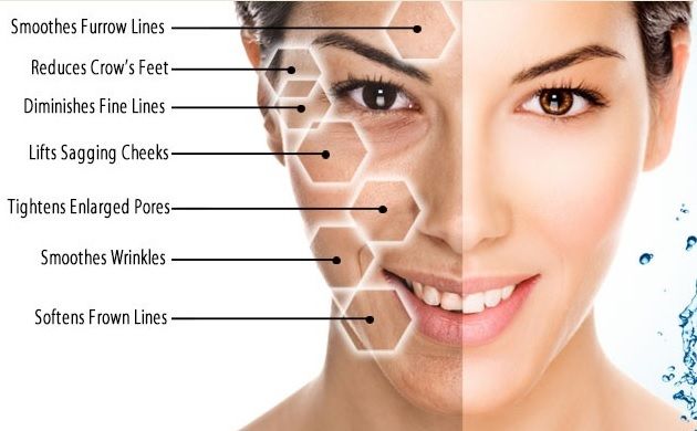 vampire face-lift areas of treatment