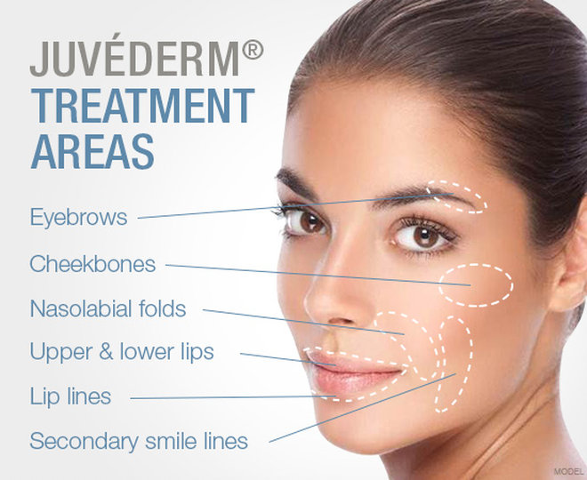 juvederm treatment areas